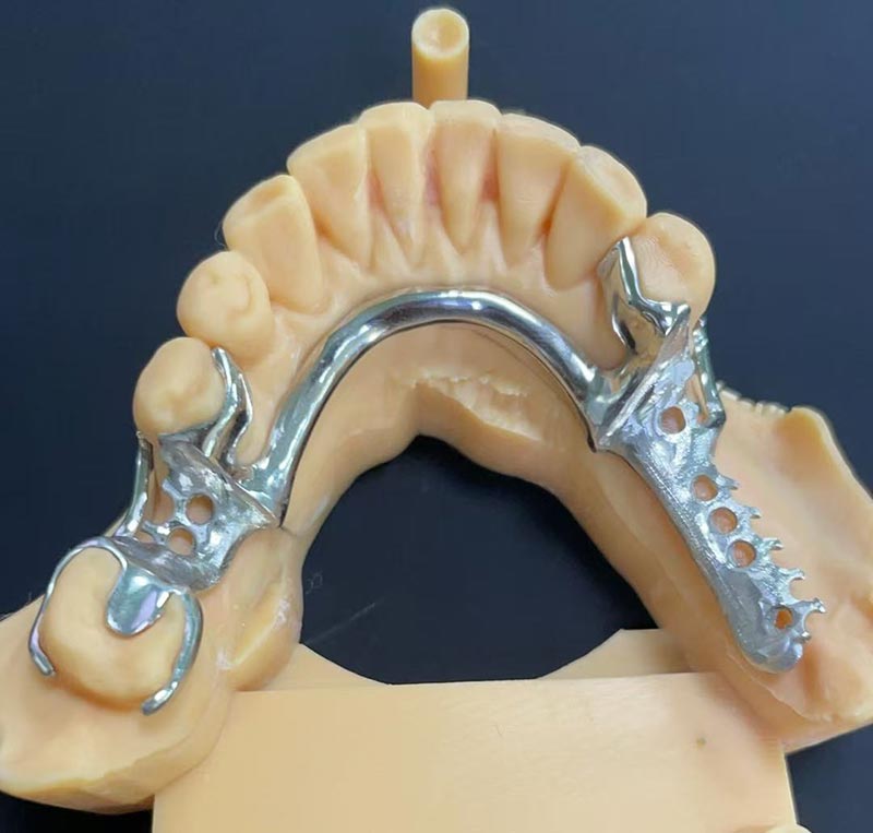 コバルトクロムフレームワーク（Co Cr フレームワーク）の利点