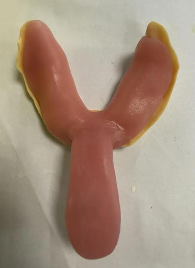 カスタム歯科用トレイについて知らなかったこと