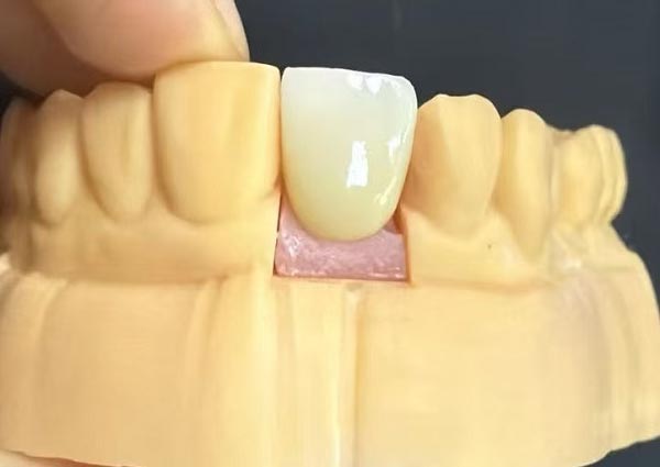 歯と歯の間の隙間は修正できます - まっすぐな歯は最も魅力的です。