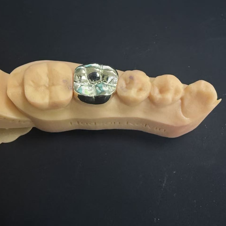 金クラウン: 生涯にわたる歯の修復のための貴金属の選択