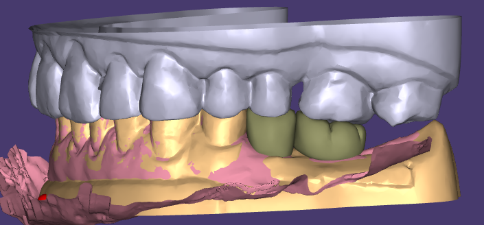 WM Dental Lab の審美的なワックスアップと仮修復は顧客から満場一致で高い評価を獲得