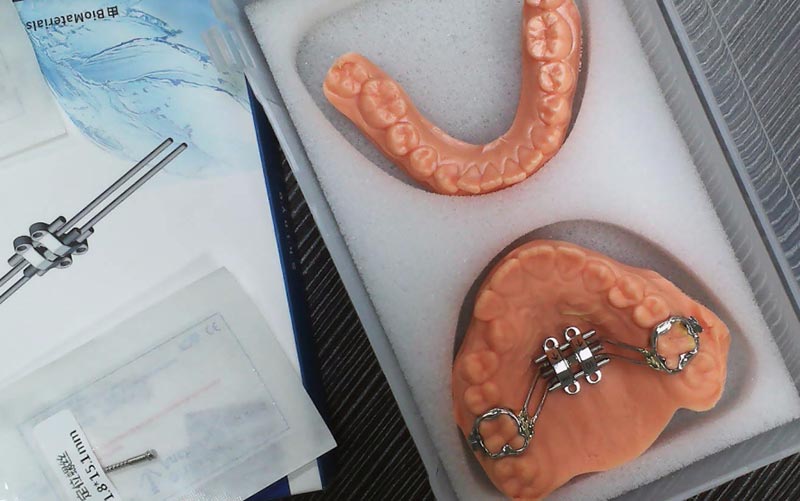 WM Dental Lab で MSE の骨格拡張を理解する