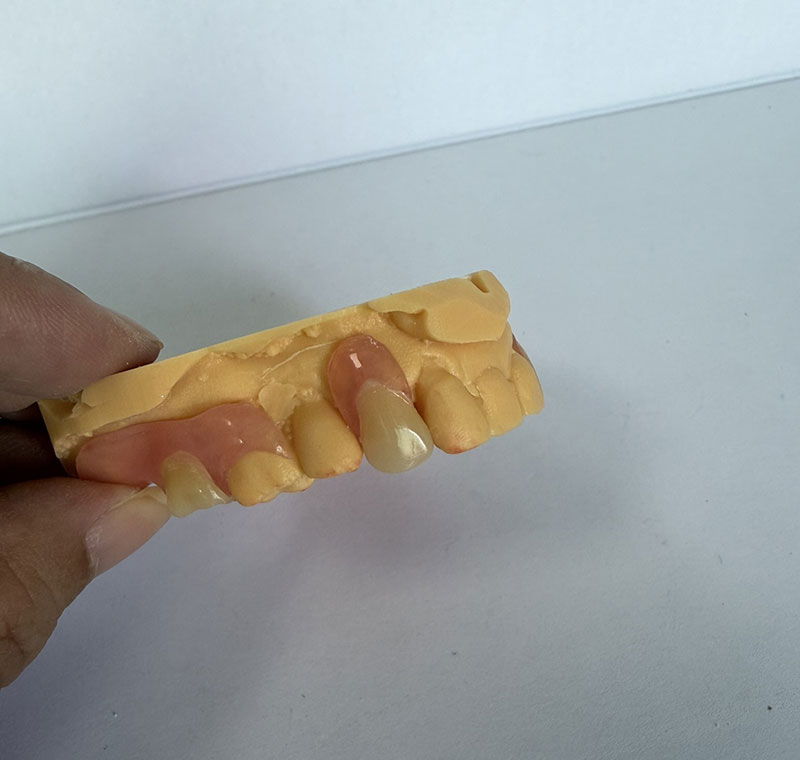 WM Dental Lab の Valplast Partials