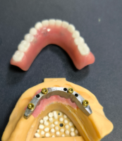 ロケーターとデンタルバー