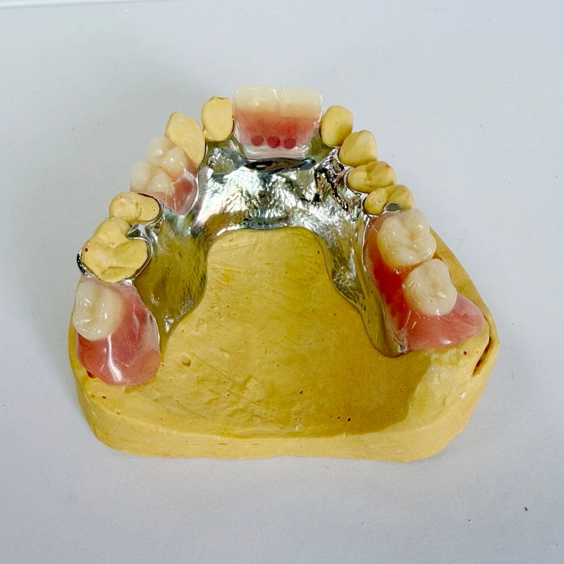 取り外し可能な修復部分フレームワーク